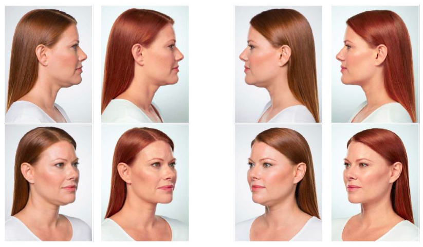 Kybella Woman Picture
