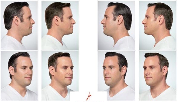 Kybella Man Picture