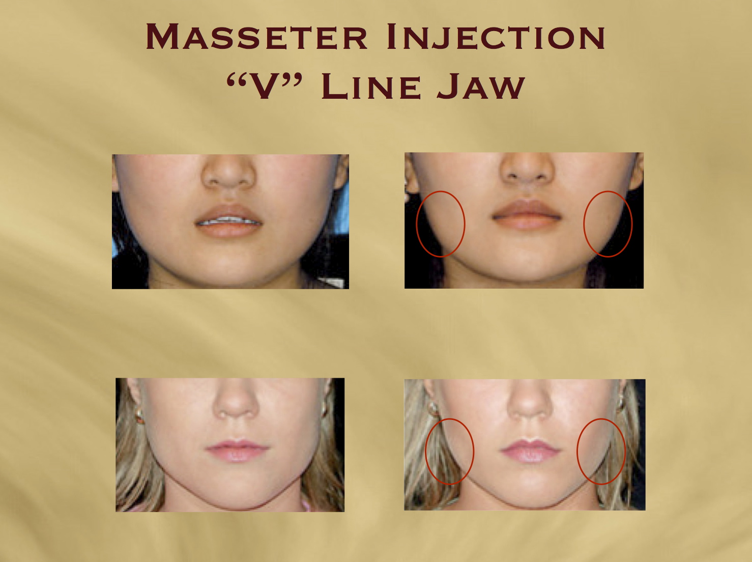 V Line Masseter Injection With Botox Square Jaw Reduction Aesthetics Hawaii