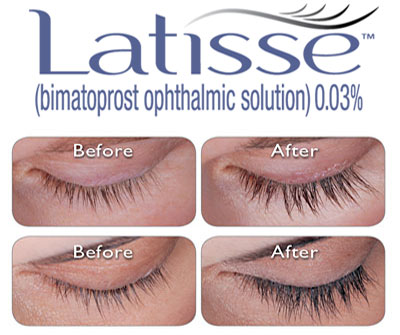 Get $100 Rebate when you buy LatisseÂ® & get treated with Botox!