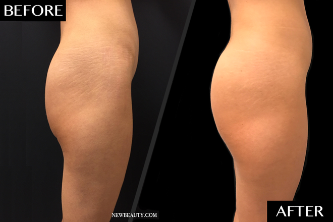 Sculptra Butt Lift Before and After