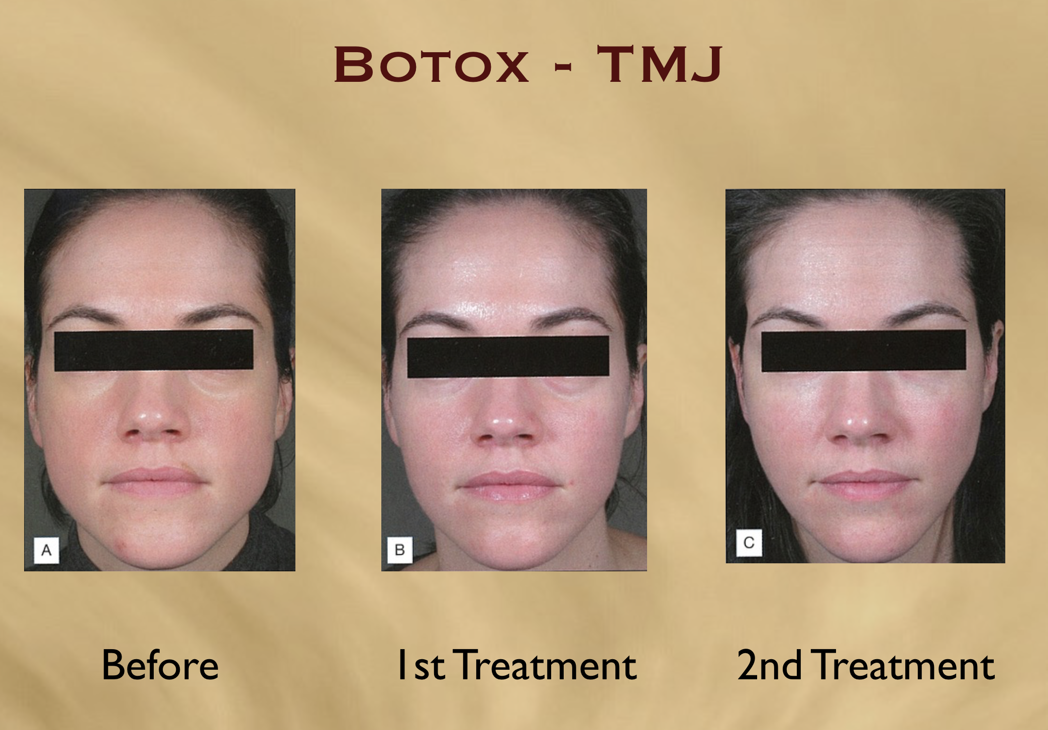 masseter botox