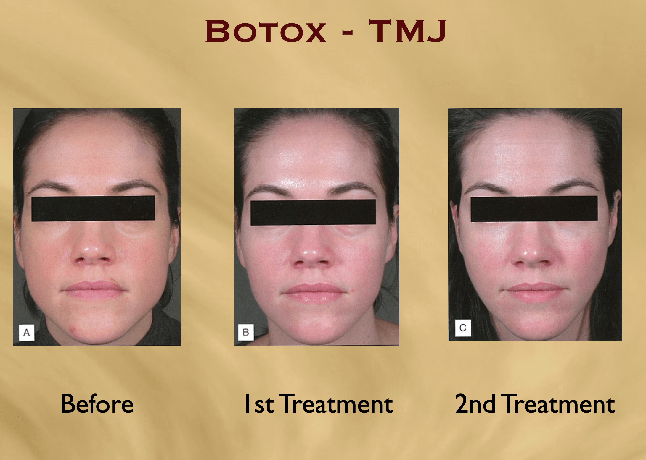 Botox For Migraines Before And After Treatment 