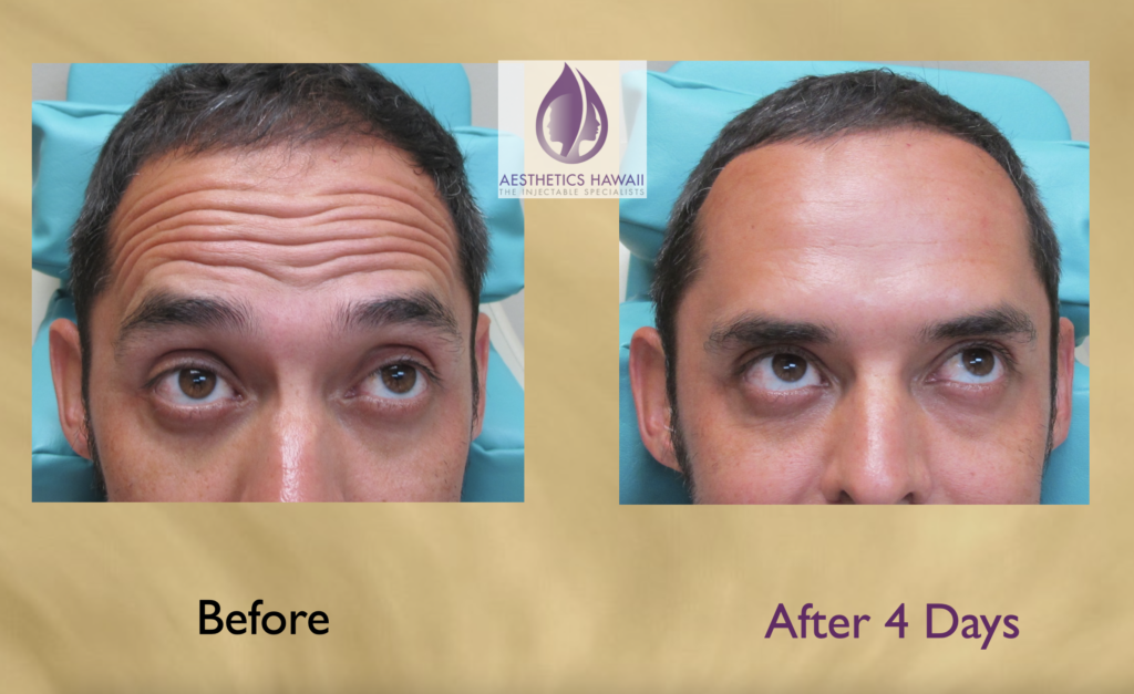 Aesthetics Hawaii - Introducing The Newest FDA Approved Botox ...