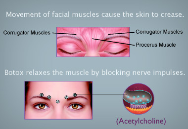 Graphic that shows how Botox works